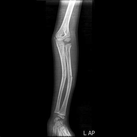 Greenstick fracture - wikidoc