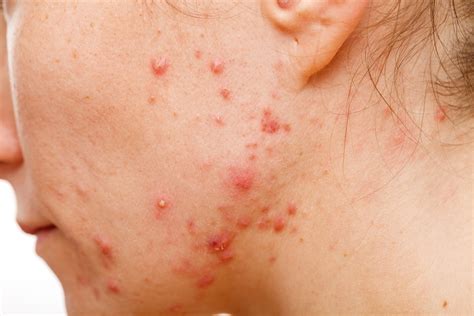 What Causes Acne Pustules? How to Get Rid of Them?