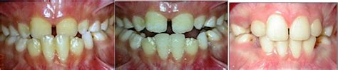 Early Treatment of Anterior Crossbite Relating to Functional Class III ...