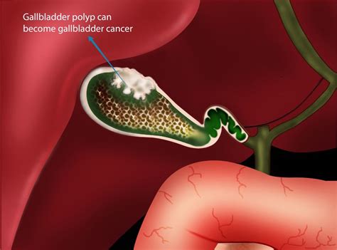 Gallbladder Polyps: Diagnosis & Treatments - Hernia & Gallbladder WA