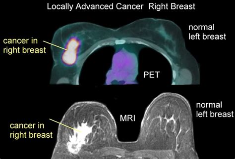 Breast PET Scans