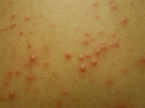 hot tub folliculitis pictures - pictures, photos