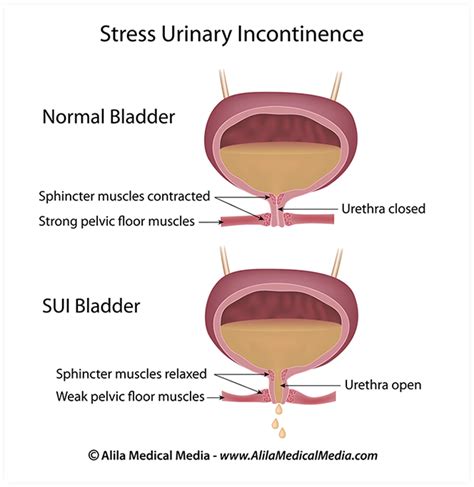 Stress Incontinence NYC - Women’s Urology New York