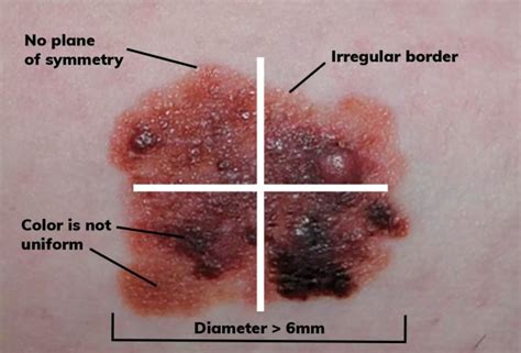 Cancerous Moles Vs Normal Moles