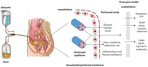 Peritoneal Dialysis Catheter Types