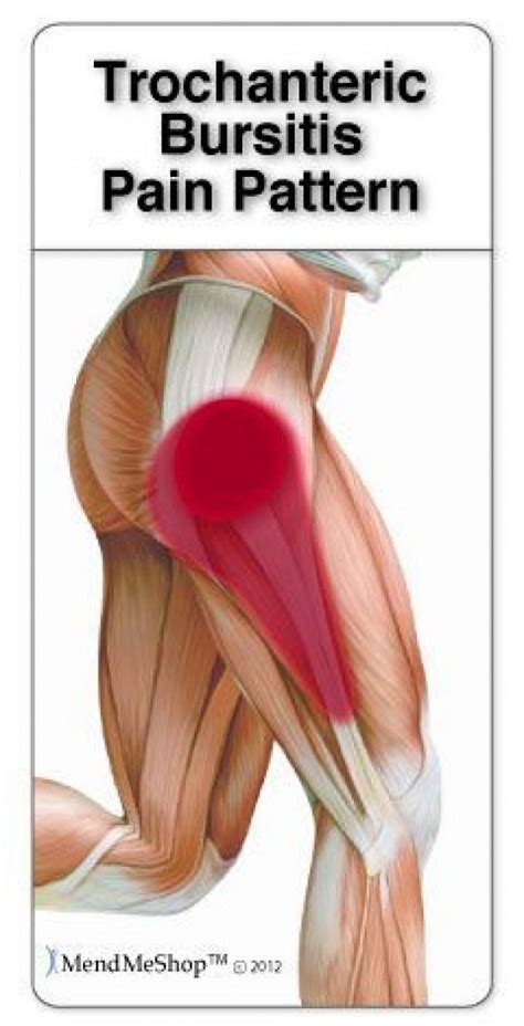 Trochanteric bursitis is often caused by the iliotibial band (IT band ...