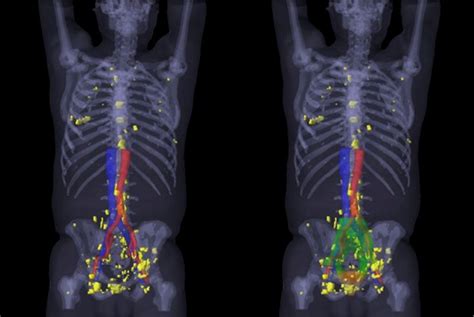 PSMA PET/CT visualizes prostate cancer recurrence early, impacts ...