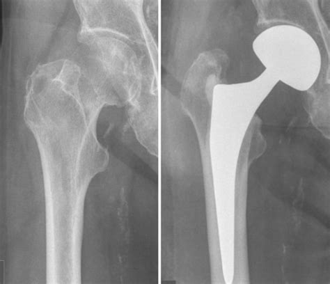 Monopolar hemiarthroplasty. Femoral neck fracture treated with unipolar ...