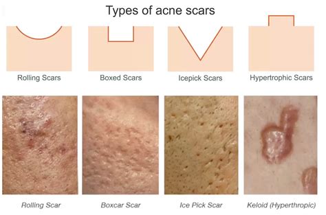 Acne Scars: Types of Acne Scarring and Ideal Treatments