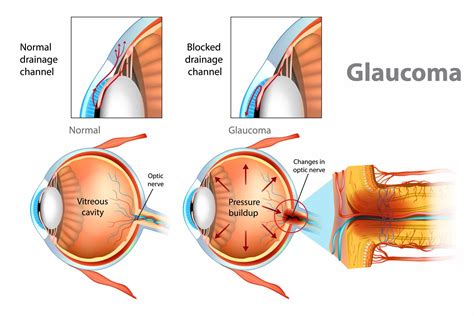 Glaucoma: Causes and Risk Factors