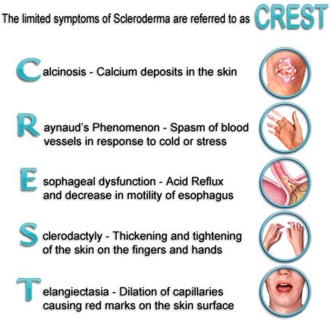 CREST Syndrome - a form of scleroderma that is a combination of ...