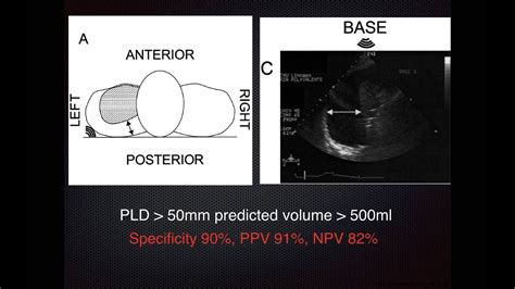 Pleural Effusion Measurement Ultrasound