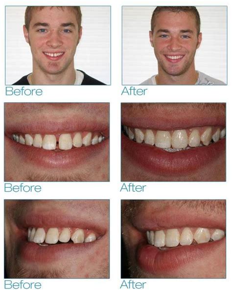 Six Month Smiles in Brooklyn - EnvySmile Dental Spa