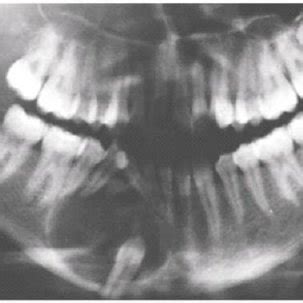 (PDF) Adenomatoid odontogenic tumor: Report of a rare case in terms of ...