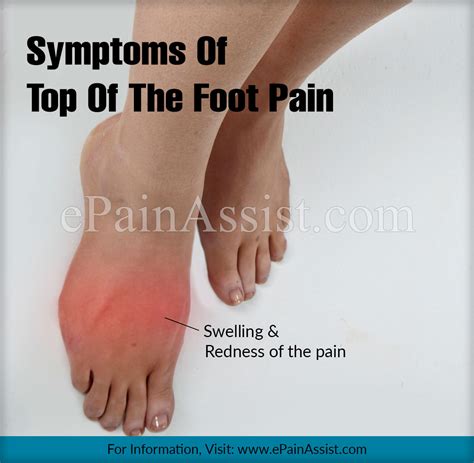 Foot Pain Diagram - exatin.info