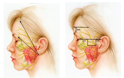 Hemifacial Microsomia - Hemifacial Microsomia Treatment