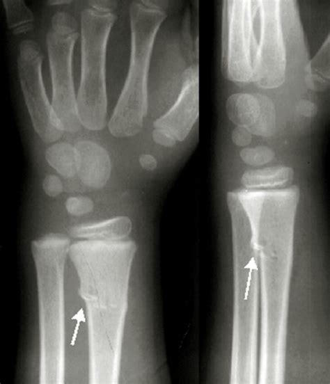 Greenstick Fracture - Pictures, Treatment, Symptoms, Healing Time ...