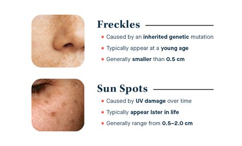 🐆 Are freckles sun damage? - Slmd Skincare