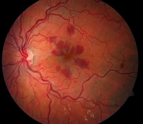 Retinopathy: Purtscher''s Retinopathy