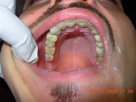 P.K. Dental Clinic: CASE: Precision attachment RPD