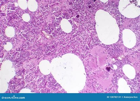 Lobar Pneumonia Histology