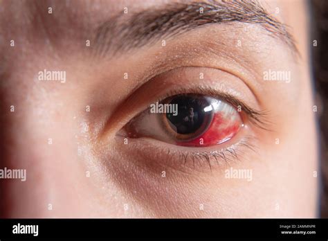 Eye hemorrhage hi-res stock photography and images - Alamy