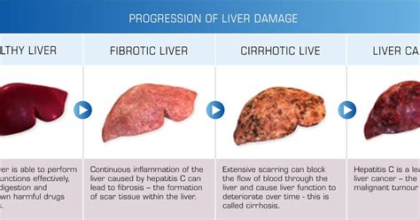 Liver Cancer Types And Stages