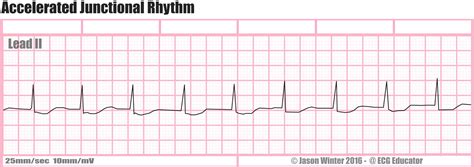 ECG Educator Blog : Accelerated Junctional Rhythm