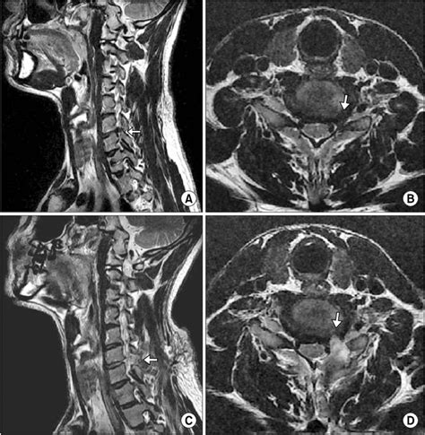 Foraminal Stenosis Mri