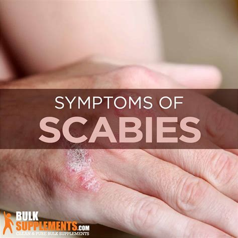 Brilliant Tips About How To Get Rid Of Scabies - Pricelunch34