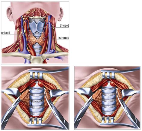 Tracheostomy Procedure Anatomy