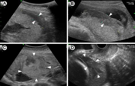 The clinical significance of large placental lakes - European Journal ...