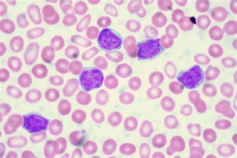 Leukemia | Definition, Causes, Symptoms, & Treatment | Britannica