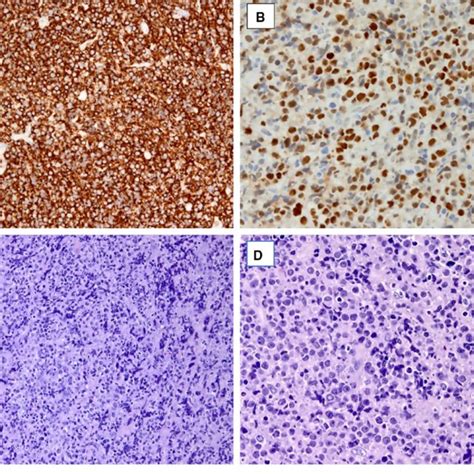 Tumor histology. High-grade diffuse large B-cell lymphoma with ...