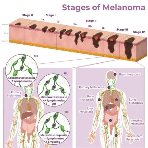 Estadios del melanoma - AIM en Melanoma Foundation