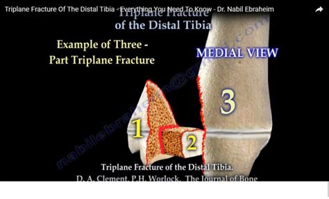 Triplane Fracture of Ankle — OrthopaedicPrinciples.com