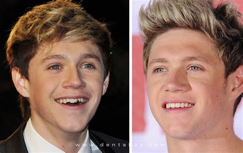 6 Celebrities Who Got Veneers: Before and After Transformations