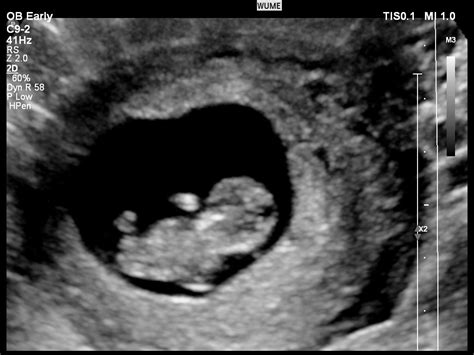 Ultrasound Week 2024 - Noemi Angeline