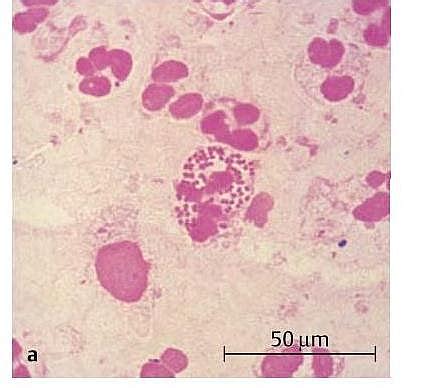 Gonorrhea Symptoms, Test, and Treatment - Jotscroll