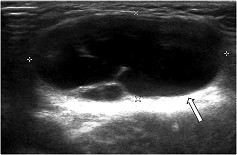 Inguinal Hernia Female Ultrasound