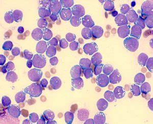 Burkitt Lymphoma – Haematological Malignancy Diagnostic Service