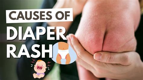 Yeast Diaper Rash (Candida Diaper Dermatitis): Symptoms, Causes ...