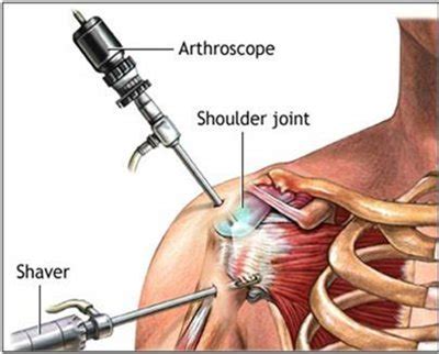 Home Exercises After Rotator Cuff Surgery: How to Do + Video