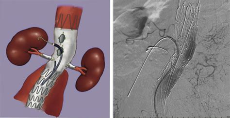 Endovascular Management of Juxtarenal Abdominal Aortic Aneurysm: A Case ...