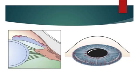 Neovascular glaucoma