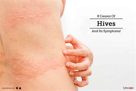 8 Causes Of Hives And Its Symptoms! - By Dr. Archit Aggarwal | Lybrate