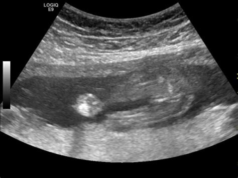 19 week ultrasound- girl? | BabyCenter