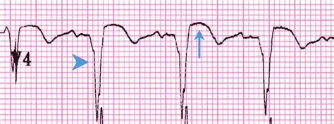 Study Medical Photos: Left Ventricular Aneurysm.- ECG