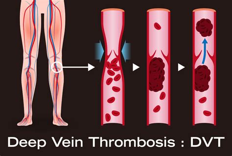 Can a DVT Cause Pain without Swelling or Redness? » Scary Symptoms