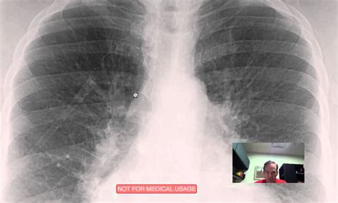 CXR Pulmonary Vascular Congestion Discussed by Radiologist.mp4 - YouTube